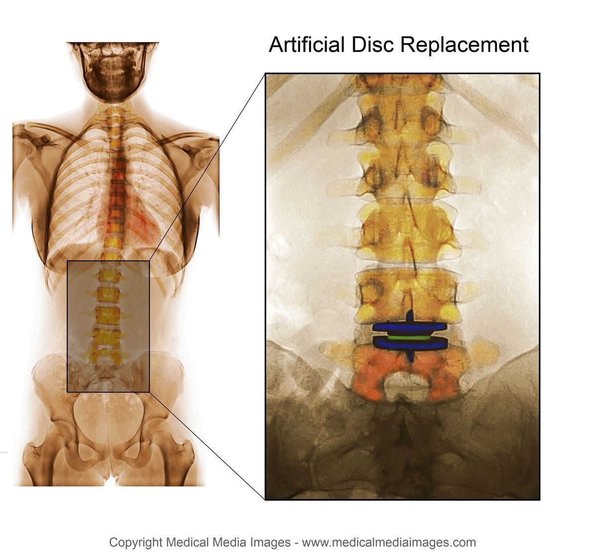 Lumbar Disc Replacement